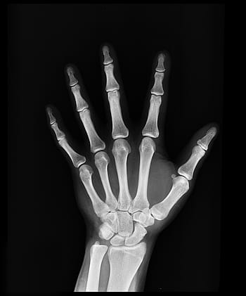 hand x-ray, x-ray, health, arm, doctors, medicine, bone, hospital, medical insurance, diagnosis, anatomy