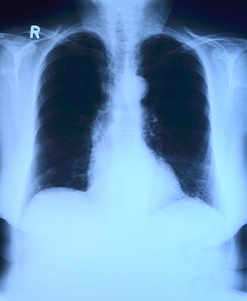rentgenový snímek, x ray image, x ray, hrudník, rentgen plic, lékařský, lékařská zkouška, zdravotnictví a lékařství, nemocnice