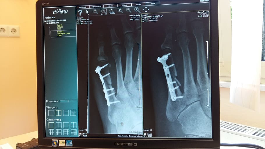 x ray, x ray image, klinika, lékařský, nemocnice, vyléčit, přezkoumat, kost, zlomenina kosti, metatarsal, metatarsální zlomenina