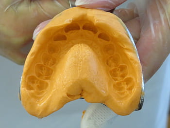 teeth, bitten, dentist, dental braces, tooth, mouth, dental brace, close up, orthodontics, dentistry, dental problems