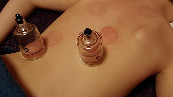 cupping, health, detoxify, homeopathy, self-healing, suction power, children, child, physiotherapy, healer, heal