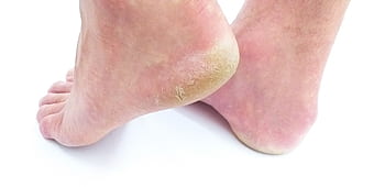 cornea, pelle, piede, pianta del piede, tacco, attrezzatura a piedi nudi, Fusspflege, fungo, umano, dolore, corpo