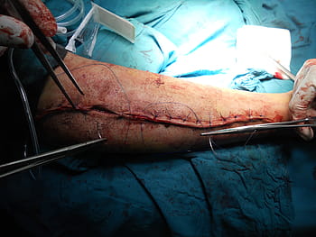 person, arm surgery, surgery, orthopedic, arm, hospital, doctor, healthcare, medicine, body, anatomy
