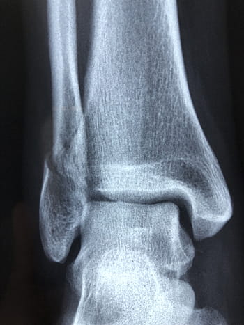 bone x-ray result, radiography, diagnosis, anatomy, injury, radiology, bone, healthcare, xray, health, medical
