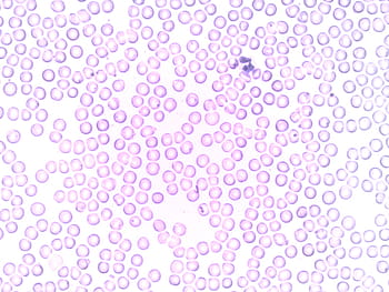 purple bubbles, Blood, Neutrophil, Segmented, segmented neutrophil, granulocyte, blood cell, laboratory, microscope, hematology, leukocyte