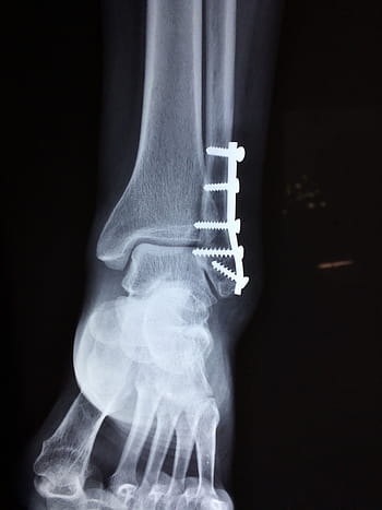 bone ultrasound result, ankle, fracture, foot, medical, accident, trauma, health, injury, leg, pain