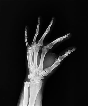 hand x-ray, x-ray, health, arm, doctors, medicine, bone, hospital, medical insurance, diagnosis, anatomy