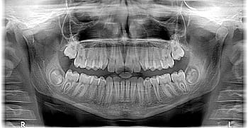 photo aux rayons x, Humain, crâne, rayons x rayons x, radiographie, roentgen, les dents, mâchoire, dentiste, orthodontiste, occlusion