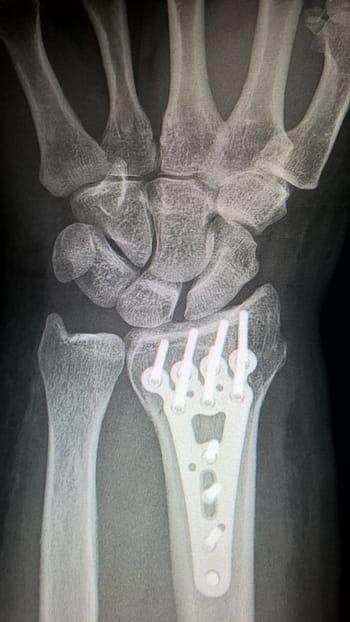 rentgenové rameno, zlomená ruka, fixace desky, titanové desky, zlomeninu poloměru, zápěstí, chirurgická operace, trauma, x ray image, kost, anatomie