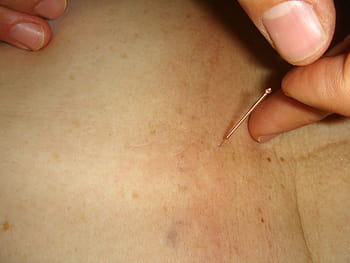 close, acupuncture pin, acupuncture, needle, acupuncture needle, skin, bless you, tcm, traditional chinese medicine, naturopathy
